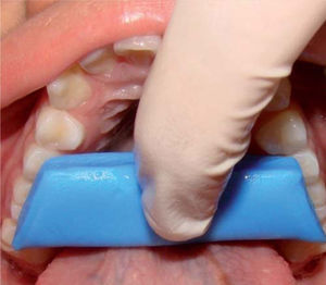 Registro de relación céntrica: técnica céntrica de poder y bloque posterior.