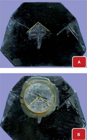 Fijación del seguro de céntrica en el vértice del trazo (relación céntrica). A. Trazo de arco gótico. B. Seguro de céntrica fijo en el vértice del trazo.