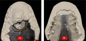 Guías para el montaje del modelo inferior con la técnica del trazo de arco gótico. A. Vista superior, B. Vista inferior.