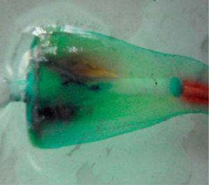 Endoposte del sistema Parapost (Coltene-Wha-ledent); también muestra el fenómeno de microfiltración a través de la interface endoposte-dentina.