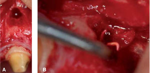 Imágenes del día de la cirugía. A) Abordaje quirúrgico. B) Eliminación del material extruido durante el curetaje.