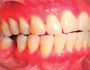 Disminución de las máculas blancas en mucosa masticatoria. Imagen en color en: www.medigraphic.com/facultadodontologiaunam