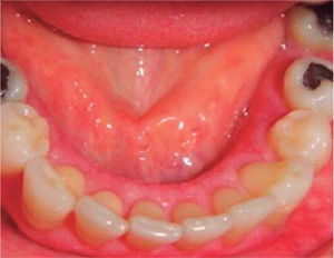 Disminución de las máculas blancas en mucosa lingual. Imagen en color en: www.medigraphic.com/facultadodontologiaunam