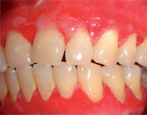 Mucosa bucal vestibular inflamada con presencia de máculas blancas. Imagen en color en: www.medigraphic.com/facultadodontologiaunam
