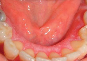 Mucosa lingual con máculas blancas. Imagen en color en: www.medigraphic.com/facultadodontologiaunam