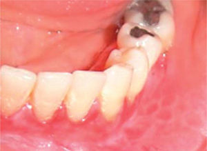 Mucosa yugal con lesiones blancas de forma anular. Imagen en color en: www.medigraphic.com/facultadodontologiaunam