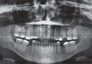Ortopantomografía que muestra pérdida ósea horizontal en ambas arcads.