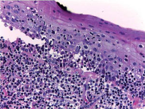 Corte histológico teñido con hematoxilina y eosina, se observa acantosis, separación epitelial del tejido conjuntivo e infiltrado inflamatorio subepitelial con predominio linfocitario. 400x.