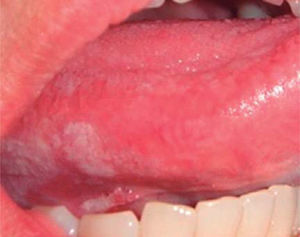 Presencia de Candida albicans pseudomembranosa en mucosa de bordes y cara ventral de lengua.