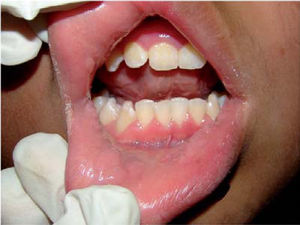 Lesiones papulares en labio inferior.