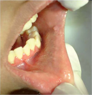 Lesiones papulares en mucosa yugal.
