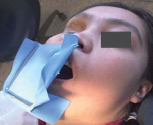 Modificación del aislamiento debido a que la paciente es respiradora bucal.