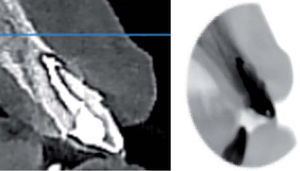 Imágenes de TAC con vista lateral en donde se puede observar la resorción radicular y el sellado de la misma.