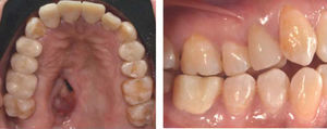 Fotografía oclusal y lateral de las restauraciones por parte de Odontología Restauradora Avanzada.