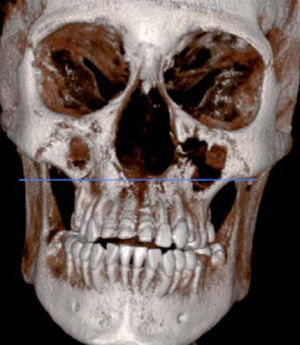 Imagen de TAC en 3D; se observa la destrucción ósea a nivel de fosas nasales y huesos cigomáticos.
