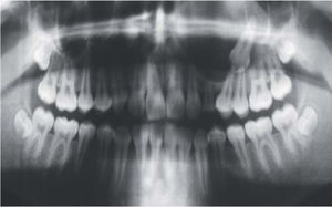 Ortopantomografía prequirúrgica, órgano dentario mesioangulado relacionado con la lesión la cual ocupa el seno maxilar, sin datos de reabsorción radicular.