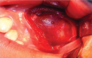 Lecho quirúrgico, tumoración bien delimitada, cubierta por una delgada membrana grisácea, indurada dentro del seno maxilar.