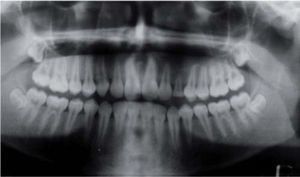Ortopantomografía postoperatoria un año, tres meses, neumatización normal del seno maxilar, canino deciduo en posición y función, sin datos de recidivas.