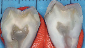 Sectioned samples. Microleakage-free obturation to enamel level can be observed.