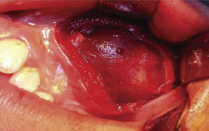 Surgical bed, well-circumscribed tumor covered by a thin layer of indurated grayish membrane within the maxillary sinus.
