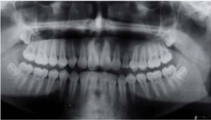 Post-operative orthopantomography, one year, three months. Normal pneumatization of the maxillary sinus, primary canine in position and function. No recurrence report.