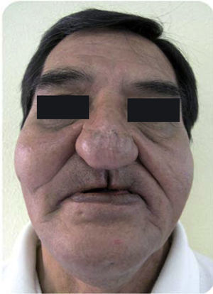 Facial collapse of middle third of the face.