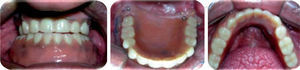 Placement of dentures in the patient.