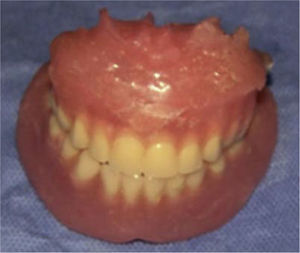 Completed dentures.