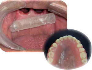 Full denture adapted to mini-implants.