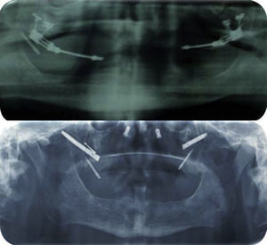 Follow-up with orthopantomographies of bone distractors and placed implants.