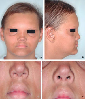 Signos característicos de DEH. A. Se puede observar cabellos y cejas escasas, hiperpigmentación perioral y periorbital. B. Se muestra puente nasal y labios prominentes. C. Arrugas perioral y periorbitales.