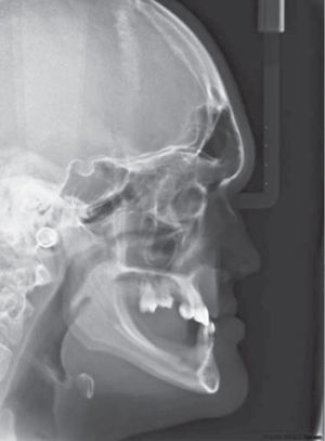 Radiografía lateral mostrando ausencia del proceso alveolar en regiones edéntulas de maxila y mandíbula.