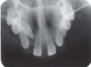 Radiografía oclusal de maxila que muestra la disposici´n de piezas dentarias presentes dentro del arco.