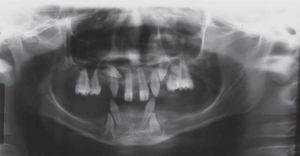 Radiografía Panorámica característica de DEH, mostrando ausencia múltiple de piezas dentarias, con presentación de 11 dientes superiores y solamente 4 inferiores, así como alteración de forma de las coronas y raíces dentarias.