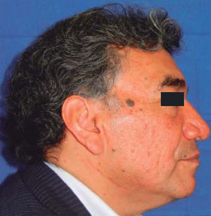 Fotografía lateral postoperatoria mostrando cicatriz de herida quirúrgica.