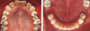 Clinical picture of upper arch (A), and lower arch (B) with oral rehabilitation.