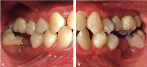 Clinical picture: right lateral clinical picture (A) and left lateral clinical picture (B) with oral rehabilitation.