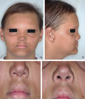 HED characteristic signs: A. Hair and eyebrows are scarce, peri-oral and periorbital hyperpigmentation can be observed. B. Evidence of prominent nose bridge and lips. C. Peri-oral and peri-orbital wrinkles.