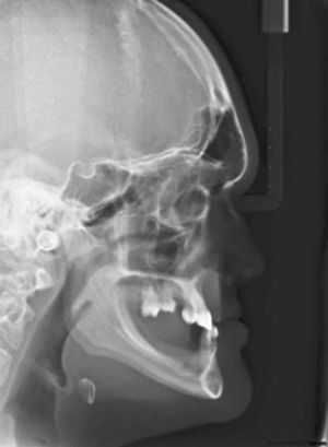 Lateral X-ray showing absence of alveolar process in toothless region of upper and lower jaws.
