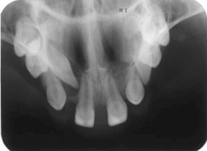 Occlusal X-ray of upper jaw showing placement of teeth present in the arch.