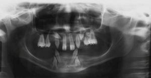 HED characteristic panoramic X-ray showing absence of multiple teeth with presence of 11 upper teeth and only 4 lower teeth, as well as shape alterations of crowns and roots.