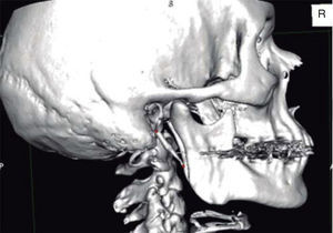 CAT with 3D reconstruction showing elongation and calcification of the stylohyoid ligament