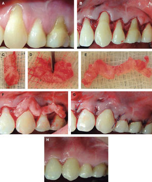 Surgical procedure with CAF + SCTG in left upper quadrant. (A) Gingival recessions before surgery.(B) Oblique incisions beginning from the largest recession. (C), (D) and (E) Graft cut in order to obtain greater extension. (F) Graft placement and adaptation. (G) Sutured, coronally displaced flap. (H) Postoperative results six months after treatment completion.