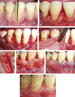 CAF + SCTG in lower right quadrant. (A) Gingival recessions before surgery. (B) Oblique incisions and de-epithelialization of interproximal papillae. (C) Partial-totalpartial thickness fl ap lifting. (D) Flap released from underlying periostium.(E) Palate graft harvesting. (F).Graft placement on root surfaces.(G) Sutured displaced flap. (H) Postoperative results six months after treatment completion.