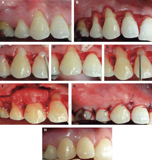 CAF + SCTG + EMD in upper right quadrant. (A) Gingival recessions before surgery. (B) Flap lifting underneath oblique incisions. (C) Placement of PrefGel on root surfaces. (D) Abundant irrigation with physiological solution to remove PrefGel. (E) Application of EMD on root surfaces. (F) Graft placed immediately after EMD application on root surfaces. (G) Flap sutured above the enamel-cement junction. (H) Healing at six months.