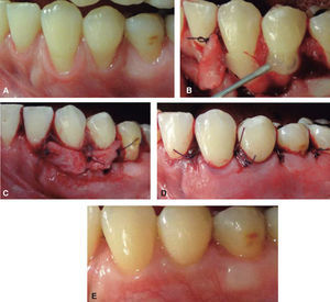 CAF + SCTG + EMD in lower left quadrant. (A) Gingival recessions before surgery. (B) EMD placement on root surfaces. (C) Graft adaptation and suture.(D) Flap suture fully covering the graft. (E) Healing six months after treatment.