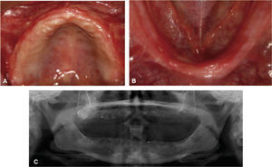 Se muestra la evolución a seis meses postquirúrgico de las preservaciones de reborde y elevaciones de piso de seno maxilar para la colocación de implantes endoóseos.