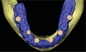 Vista del encerado diagnóstico en tercera dimensión en la mandíbula.