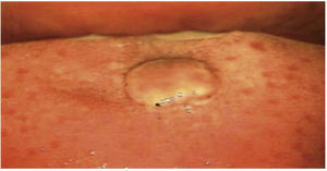 Inspección de la cavidad oral directa bajo visión colposcópica (Hinselmann, 2014), con aumento de 0.66x. Lesión de 1cm de diámetro, color rosa, circular, de bordes mellados, sin pedículo y avascular.