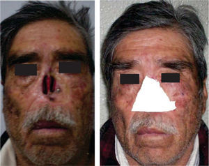 Paciente con cartílago nasal destruido, después de la intervención quirúrgica, y defecto cubierto con gasas.